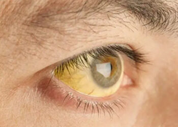 तपाईंले कतै ‘जन्डिस’ का बारेमा यस्ता भ्रम त पाल्नु भएको छैन?