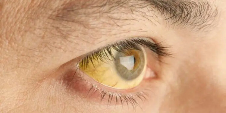 तपाईंले कतै ‘जन्डिस’ का बारेमा यस्ता भ्रम त पाल्नु भएको छैन?